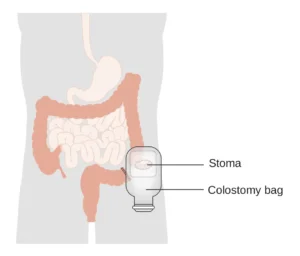 Stoma with colostomy bag